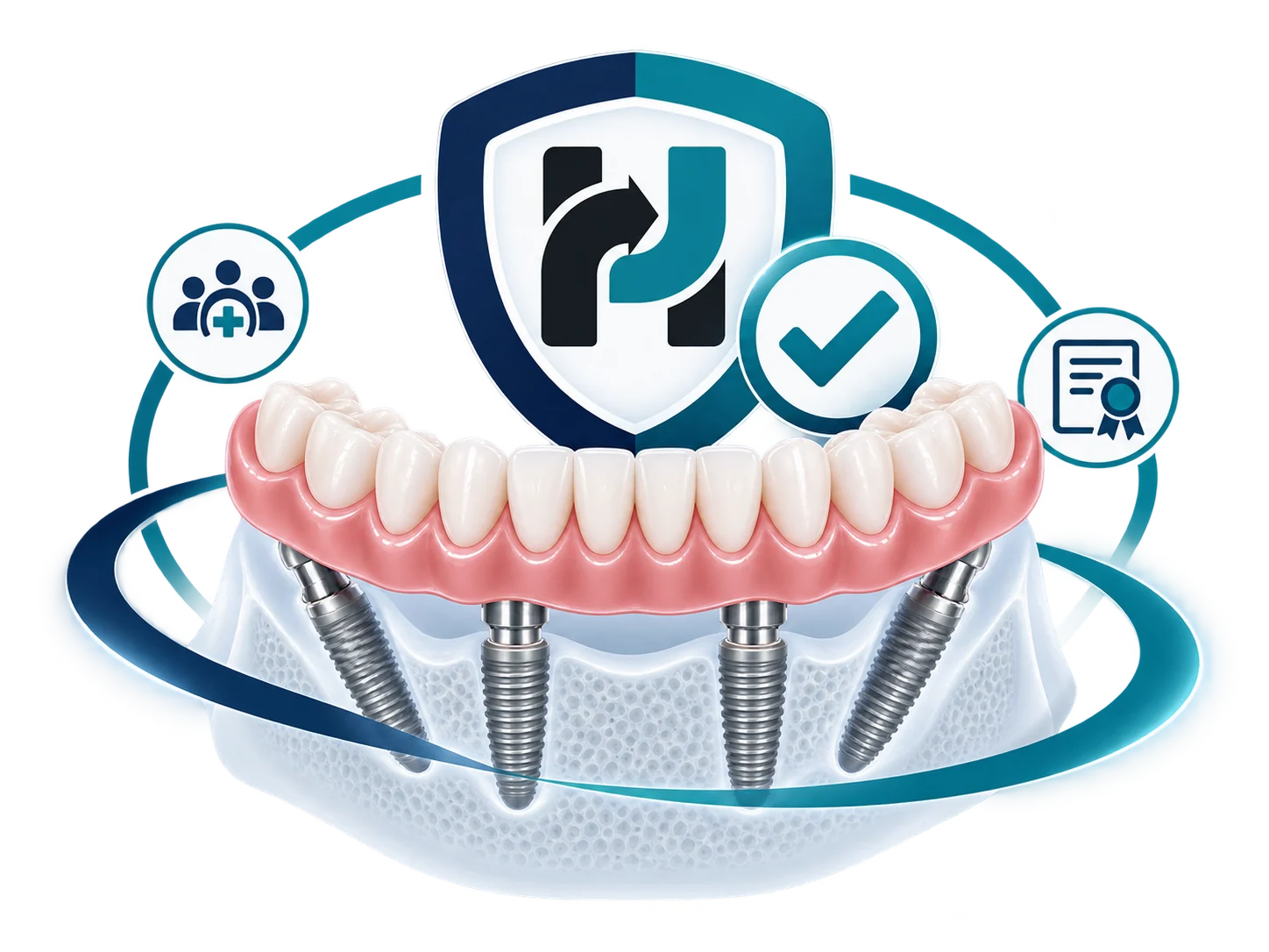 All-on-4 warranty illustration